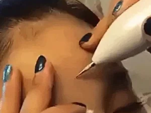 CAUTERIZADOR FACIAL